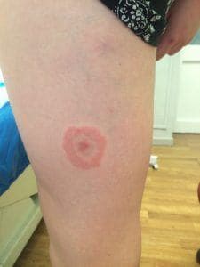 Where can you find photos of tick bites?